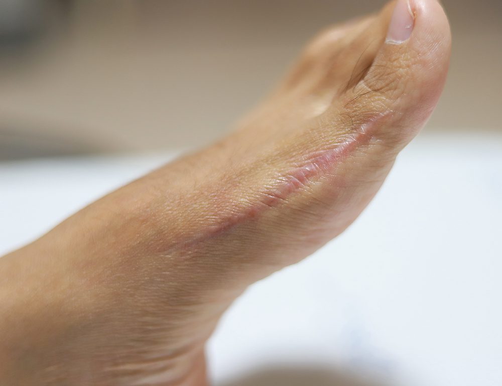 Bunion Surgery_284554041