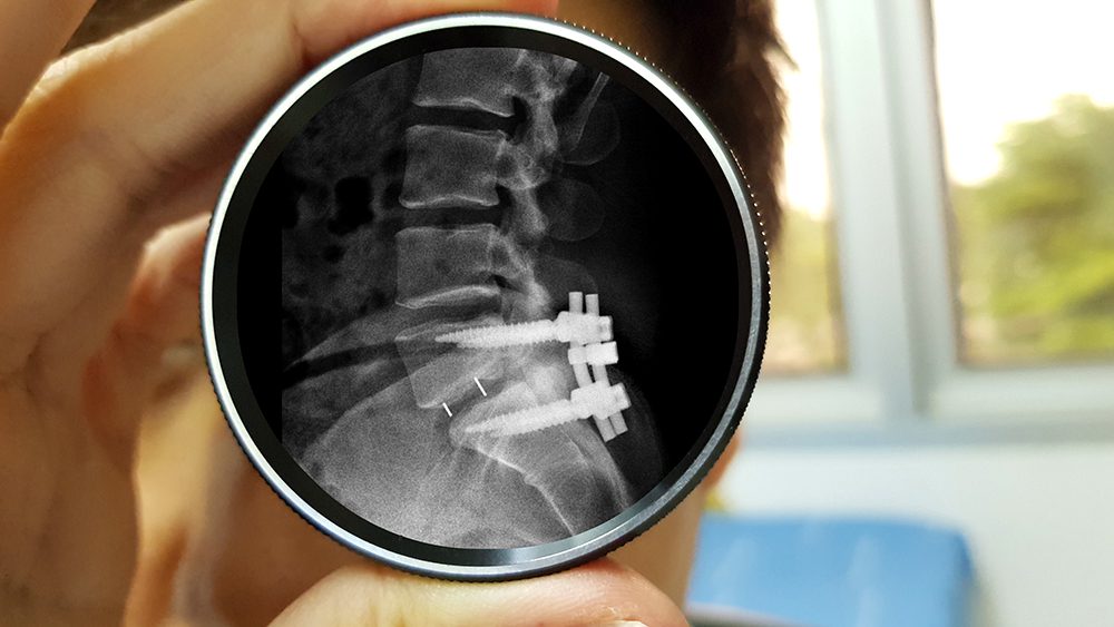 We're taking a closer look at spinal fusion and how it has helped hundreds of patients by alleviating back pain.