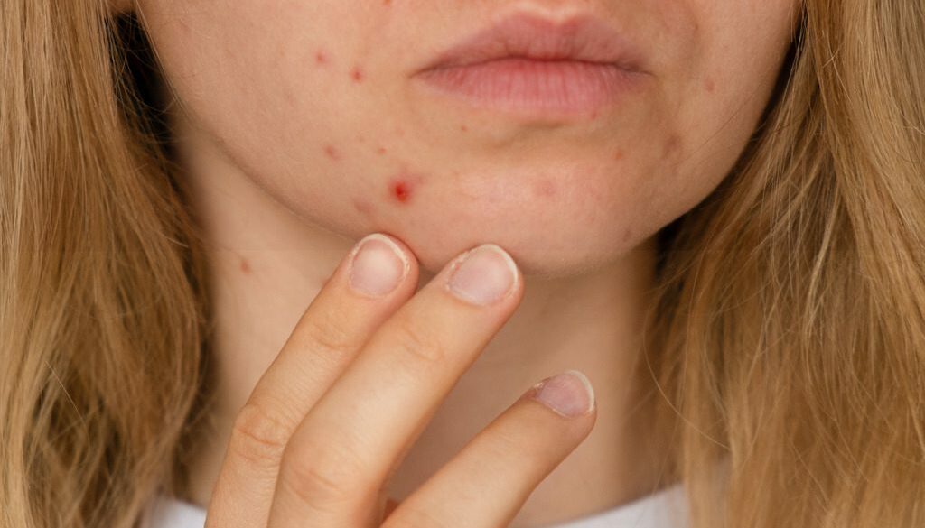 Woman Who Needs Dermatology Acne Treatment