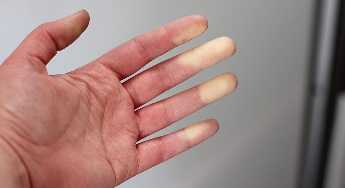 Cold Fingers, 6 Causes, Raynaud's Disease, & What To Do